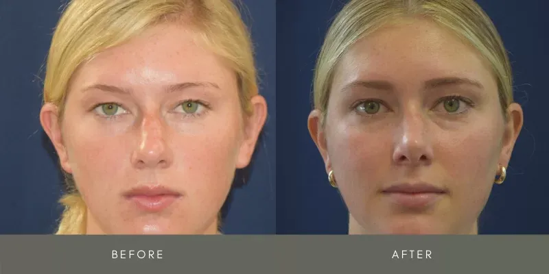 Rhinoplasty Before & After
