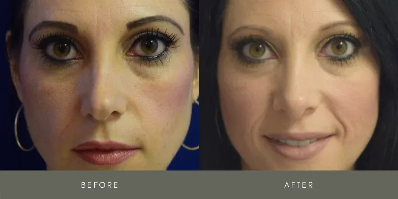 Rhinoplasty Before & After