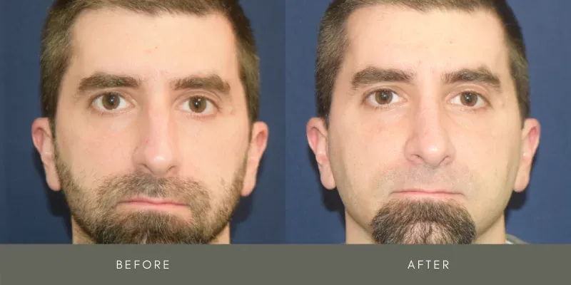 Rhinoplasty Before & After