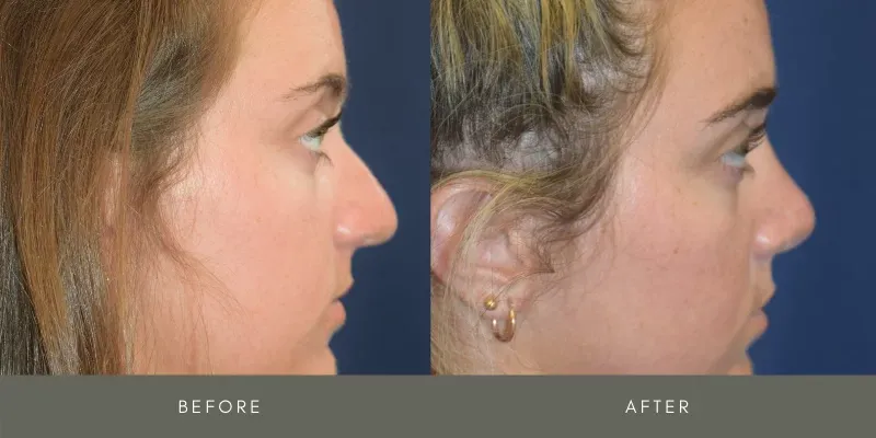 Rhinoplasty Before & After