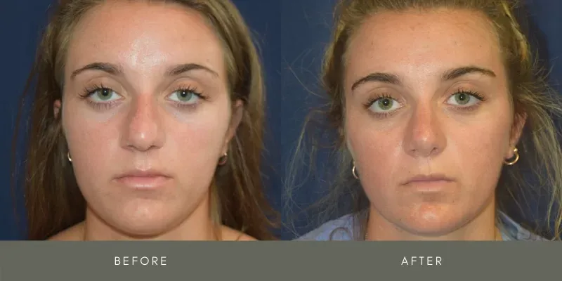 Rhinoplasty Before & After