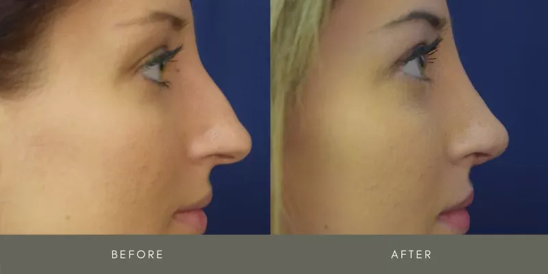 Rhinoplasty Before & After