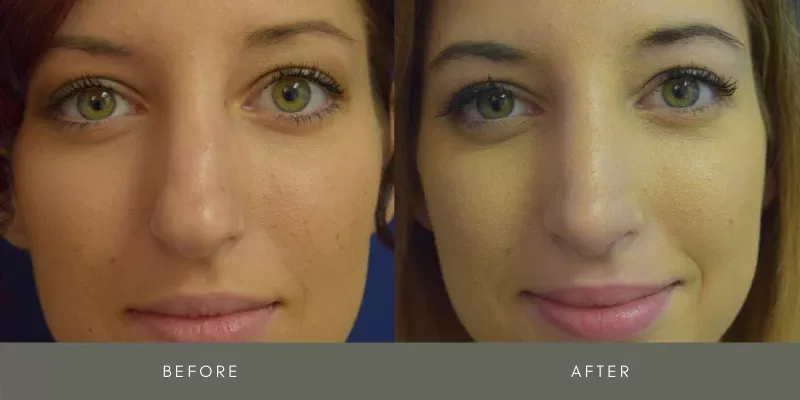 Rhinoplasty Before & After