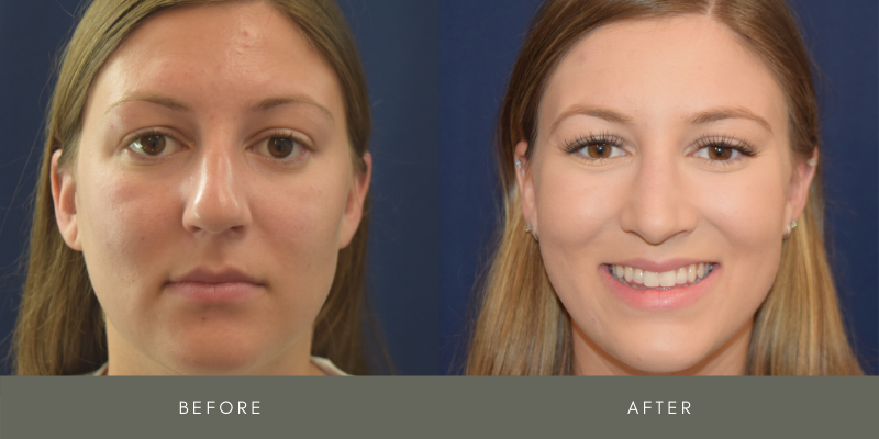Rhinoplasty Before & After