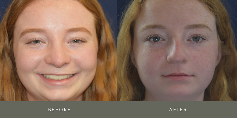 Rhinoplasty Before & After