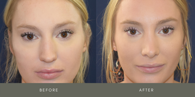 Rhinoplasty Before & After