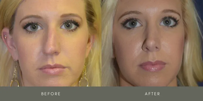 Rhinoplasty Before & After