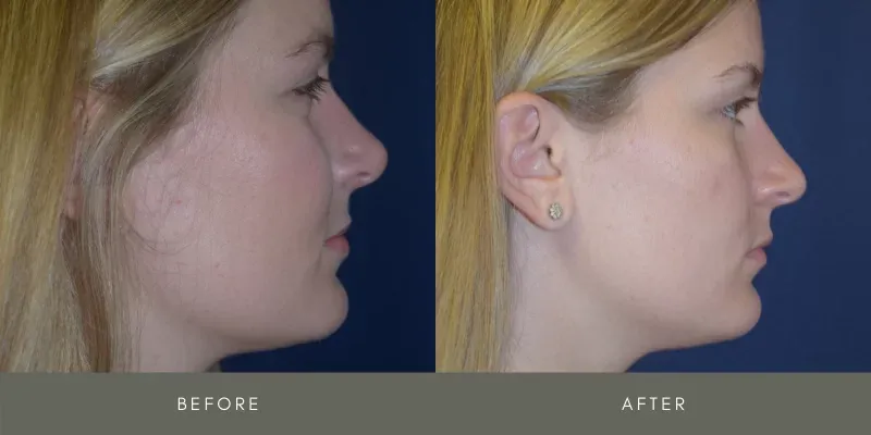 Rhinoplasty Before & After