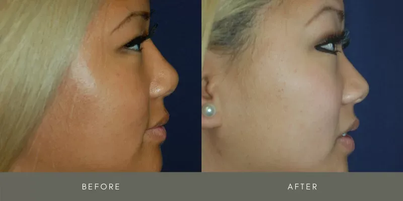 Rhinoplasty Before & After