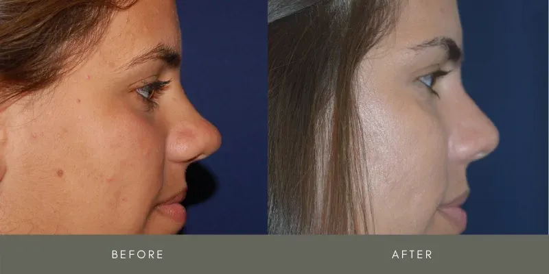 Rhinoplasty Before & After