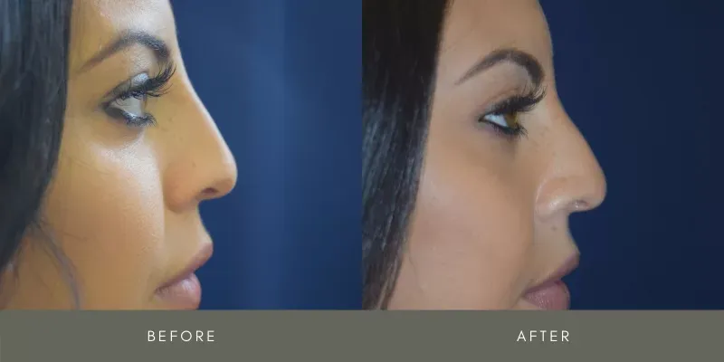 Rhinoplasty Before & After