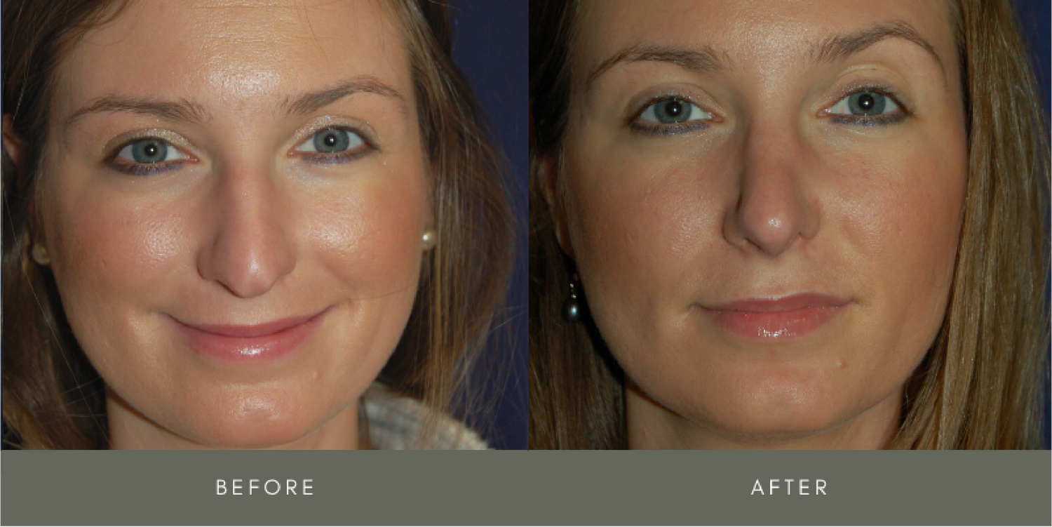 Rhinoplasty Before & After