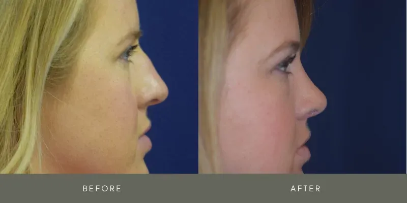 Rhinoplasty Before & After