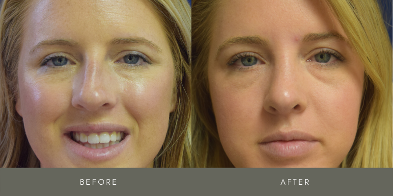 Rhinoplasty Before & After