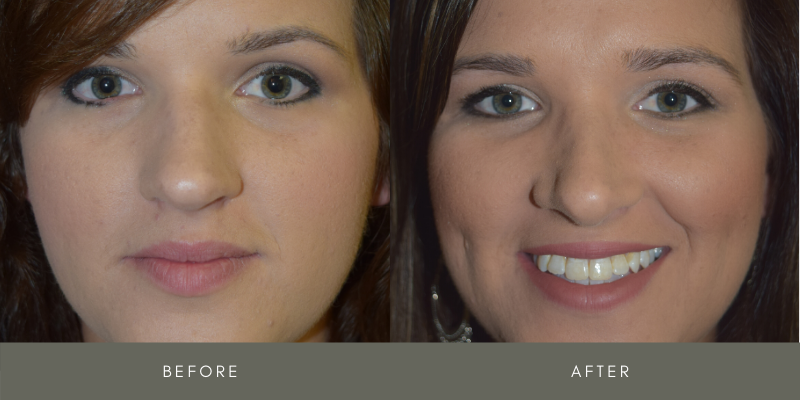 Rhinoplasty Before & After