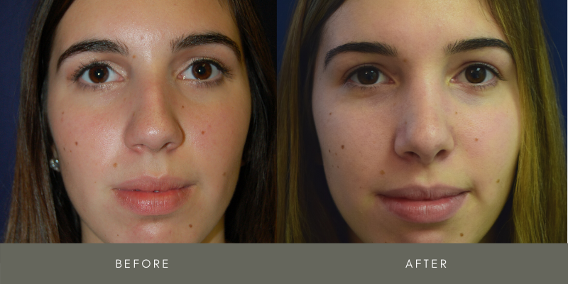 Rhinoplasty Before & After