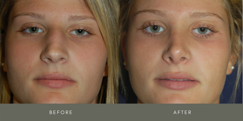 Rhinoplasty Before & After