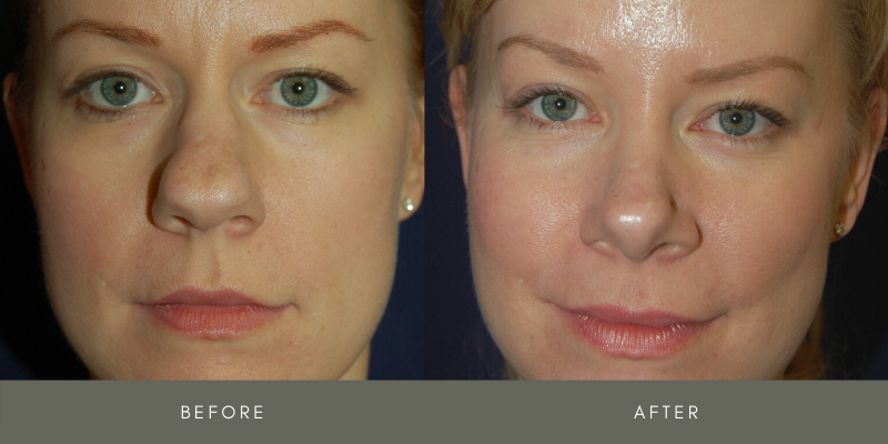 Rhinoplasty Before & After