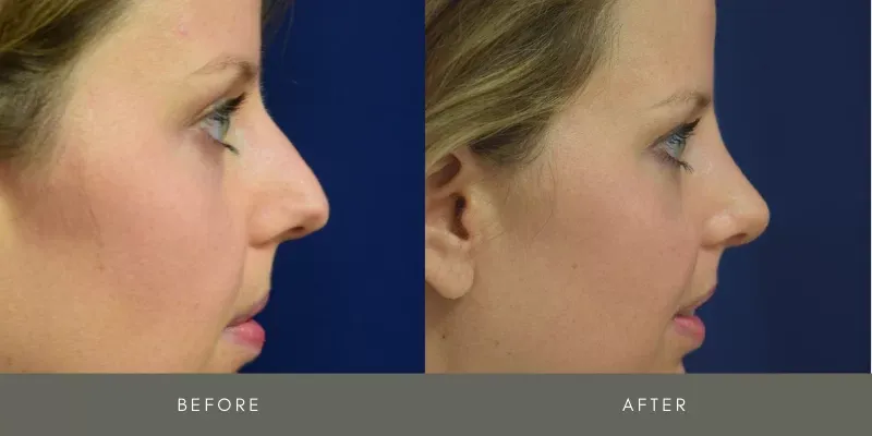 Rhinoplasty Before & After