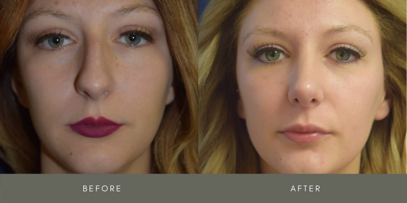 Rhinoplasty Before & After