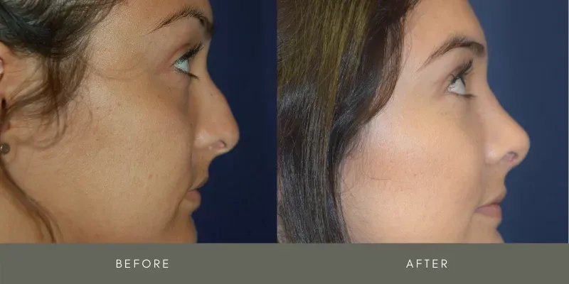 Rhinoplasty Before & After