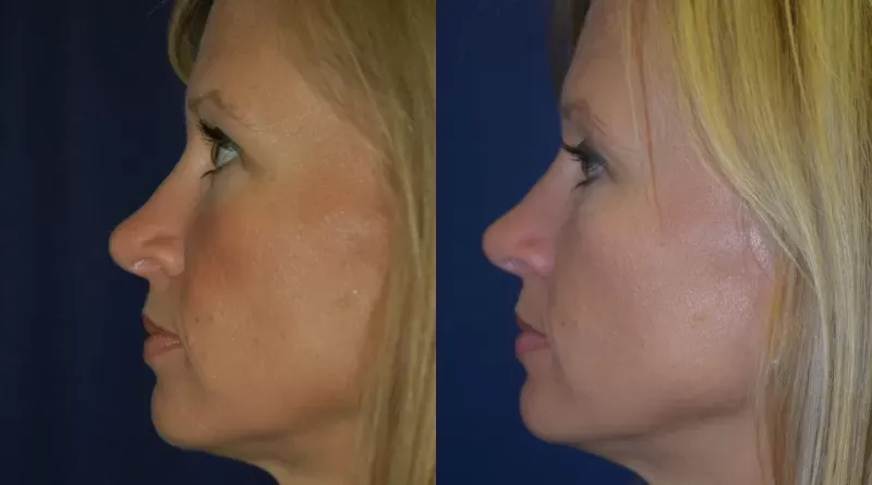 Rhinoplasty Before & After