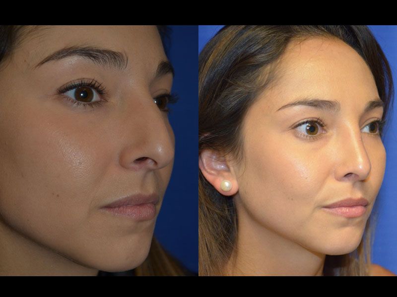 Rhinoplasty Before & After