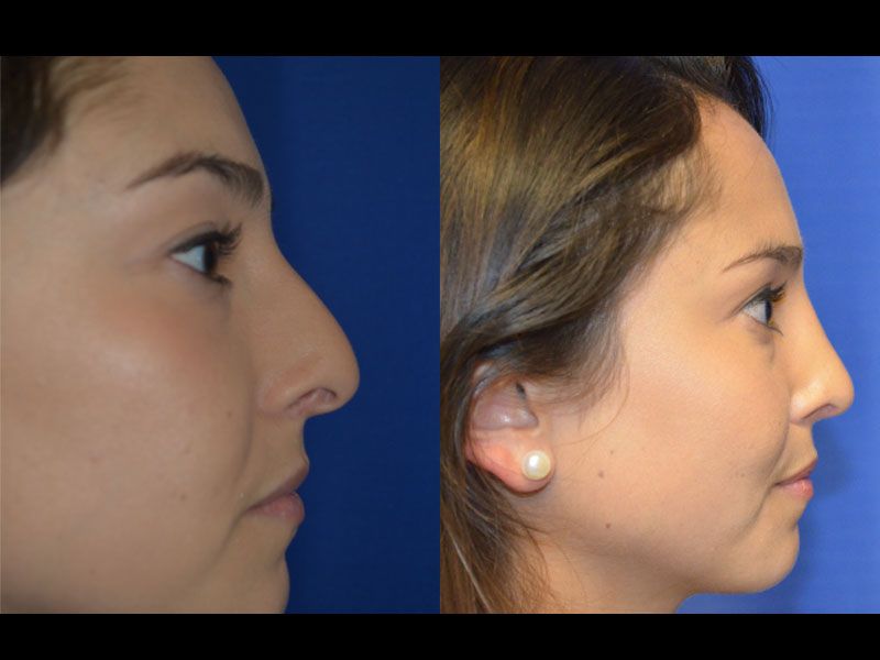 Rhinoplasty Before & After
