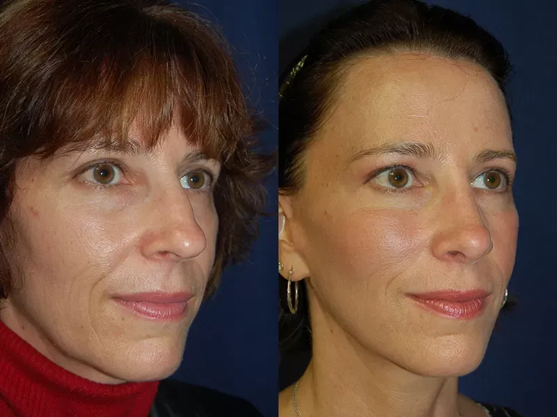 Rhinoplasty Before & After