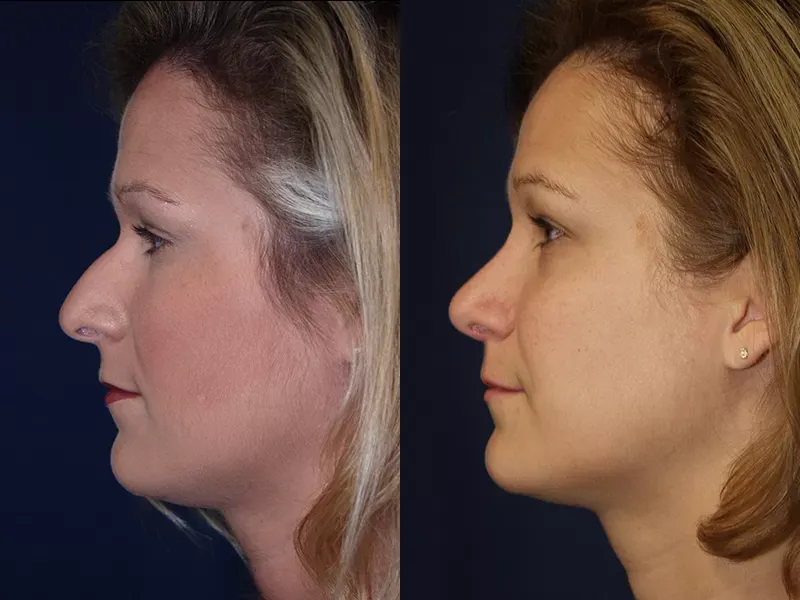 Rhinoplasty Before & After