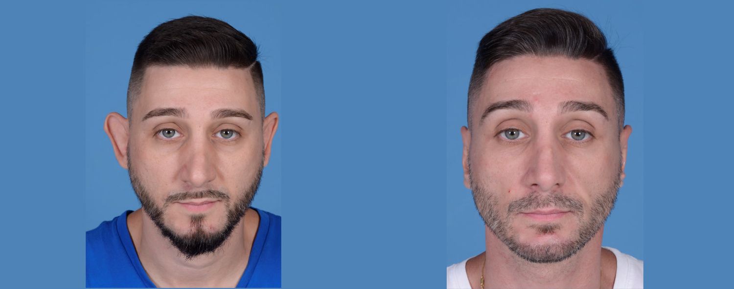 Rhinoplasty Before & After