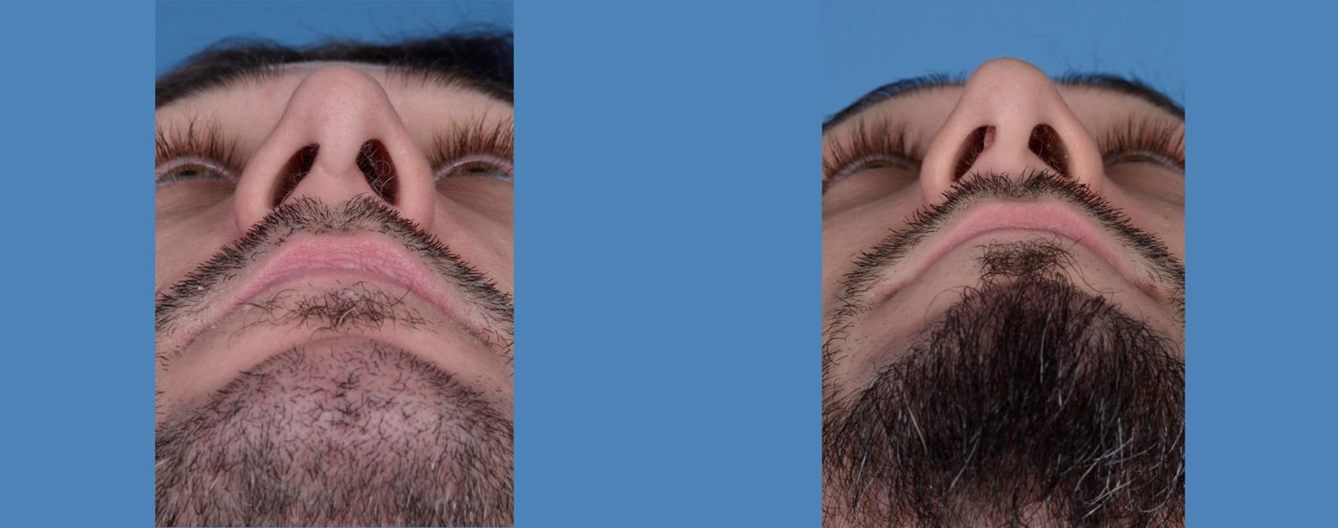 Rhinoplasty Before & After