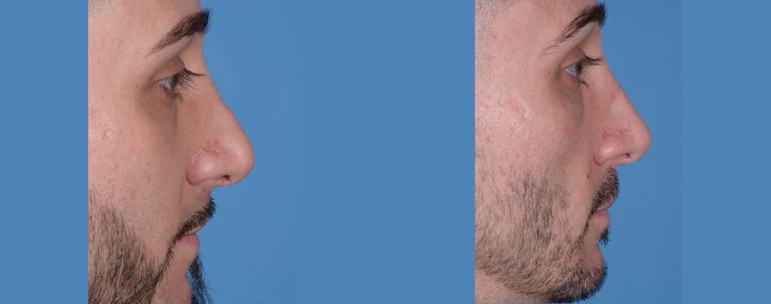 Rhinoplasty Before & After