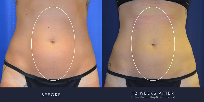 Coolsculpting Before & After