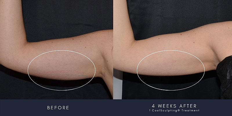 Coolsculpting Before & After