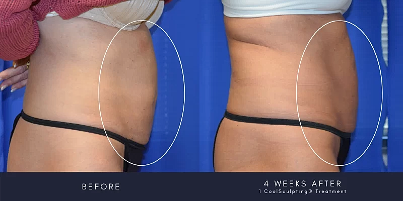 Coolsculpting Before & After