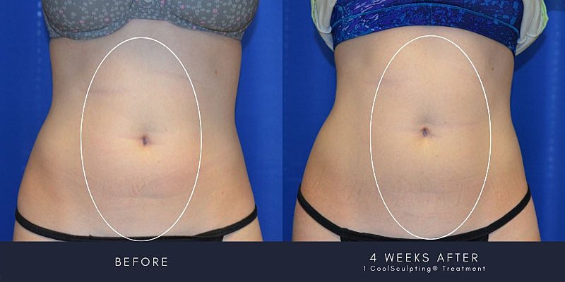 Coolsculpting Before & After
