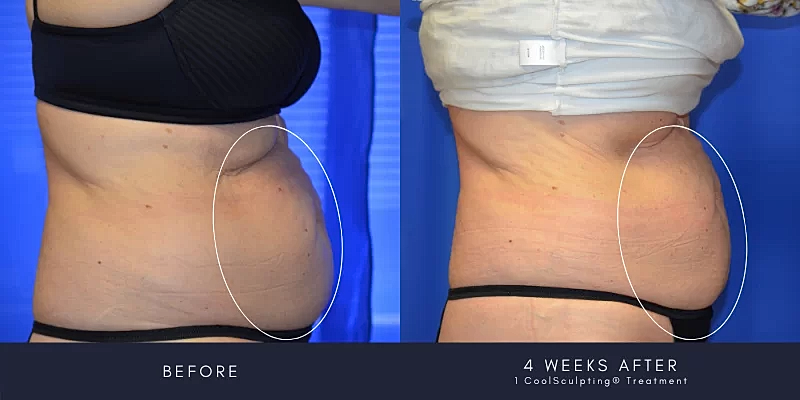 Coolsculpting Before & After