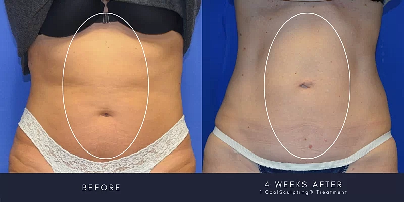 Coolsculpting Before & After
