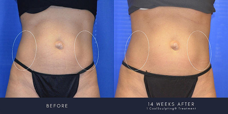 Coolsculpting Before & After