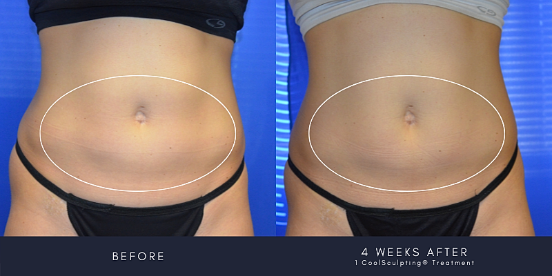 Coolsculpting Before & After