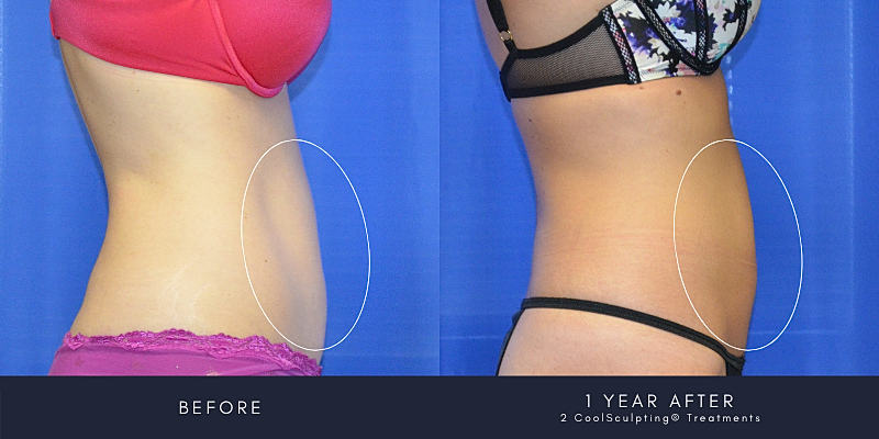 Coolsculpting Before & After