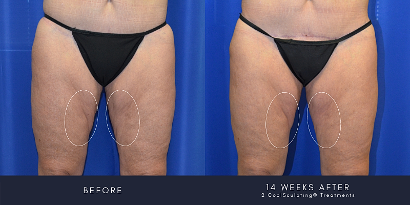 Coolsculpting Before & After