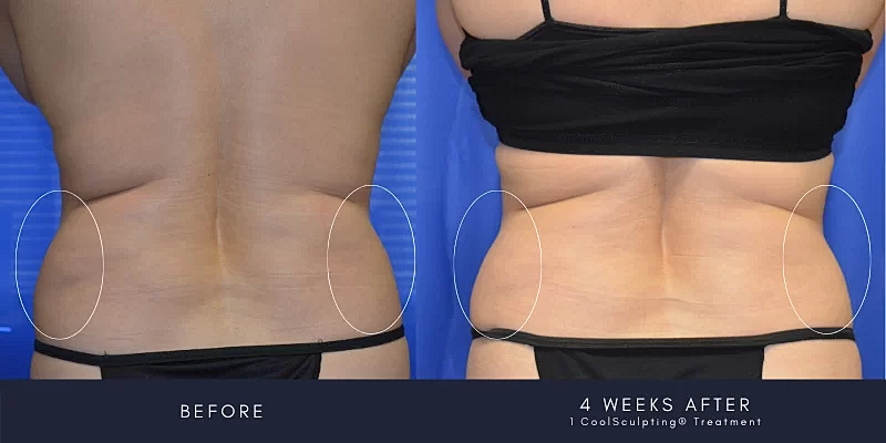Coolsculpting Before & After
