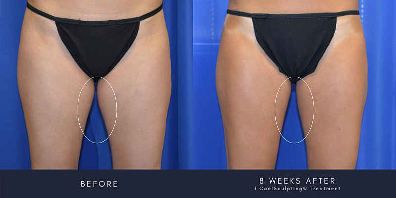 Coolsculpting Before & After