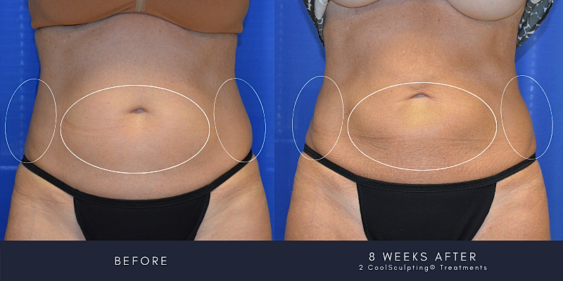 Coolsculpting Before & After