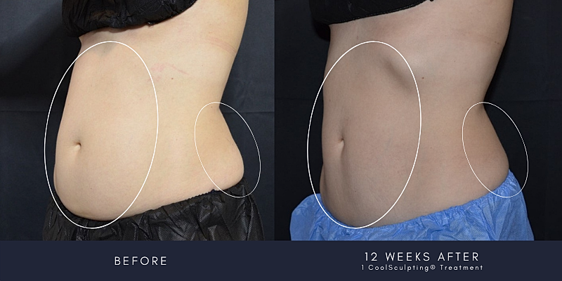 Coolsculpting Before & After