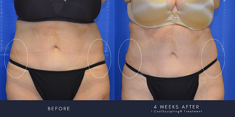 Coolsculpting Before & After