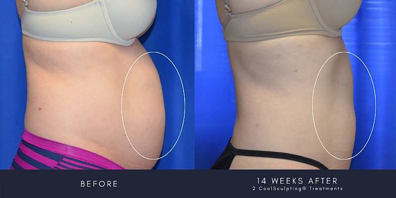 Coolsculpting Before & After