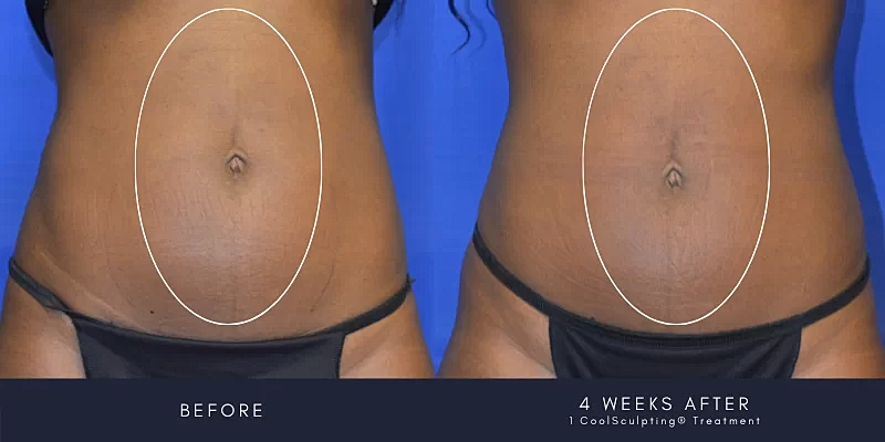 Coolsculpting Before & After